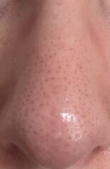 Anyone tried skin peels at home? Need something for the revolting blackheads or SFs on my nose.