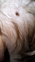 Need a handhold - urgent derm referral for a bad scalp mole 3yo