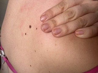 Does this mole look normal?