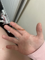 7dpo spotting and migraines while trying to conceive, could it be implantation?