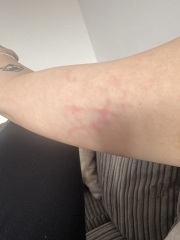 Red lines on skin