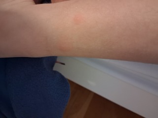 To ask if these are bed bug bites