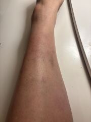 Does anyone know what these marks are on my leg please?