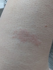 Large red mark after injection