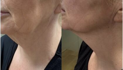Tightening your jawline at 60