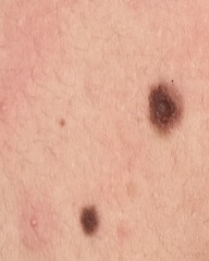 Does this mole look normal?