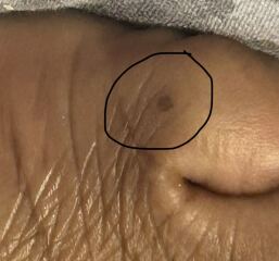 Mole on feet any advice please ?