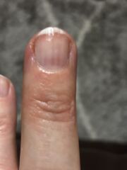 Scabies (again!) How long to get believed that you still have it following treatment?!