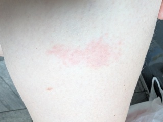 Large red mark after injection