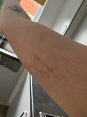 Red lines on skin