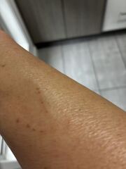 Scabies (again!) How long to get believed that you still have it following treatment?!