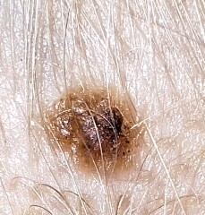Need a handhold - urgent derm referral for a bad scalp mole 3yo