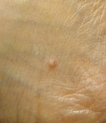 Two long-standing skin lumps on ankle and shin: any ideas?