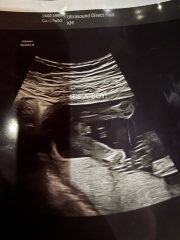 Potty shot 17 weeks 1 day