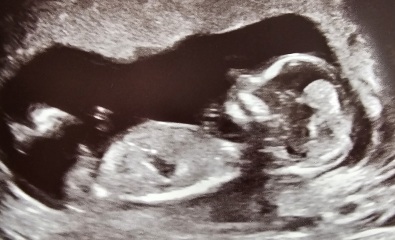 Boy or Girl guesses at 13 weeks 4 days scan?