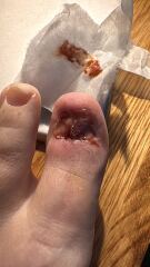 Still not infected-help?