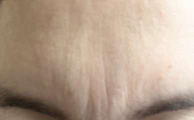 Thinking my wrinkles are excessive?