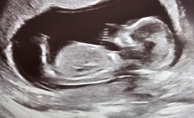 Boy or Girl guesses at 13 weeks 4 days scan?