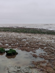 Retroperitoneal Leiomyosarcoma part 2