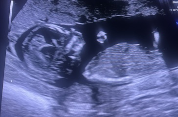 Midwife’s gender guess v nub theory?