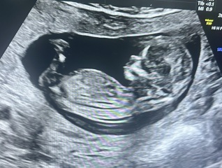 Midwife’s gender guess v nub theory?
