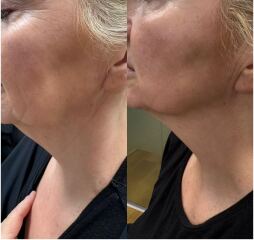 Tightening your jawline at 60