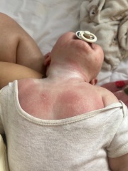 Eczema flares all over body, rash, allergy?