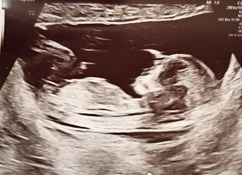 Can anyone guess the baby’s gender from the 13 week nub scan?