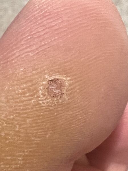 A verruca? Podiatrist says not?