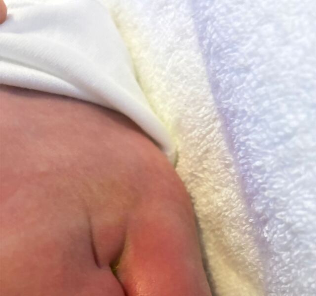 Newborn and dimple on base of spine