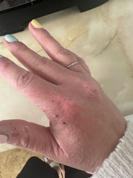 My hands are driving me insane with dry skin