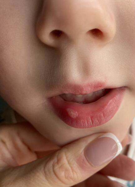Ulcer or cold sore?