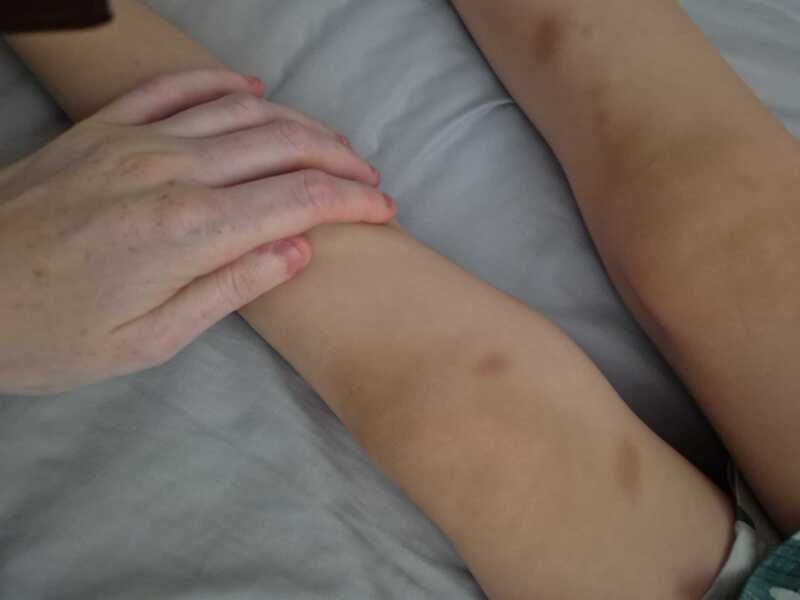 My youngest keeps bruising.