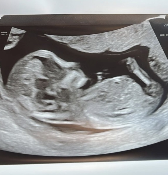 Any nub theory guesses at 13 weeks and 1 day?