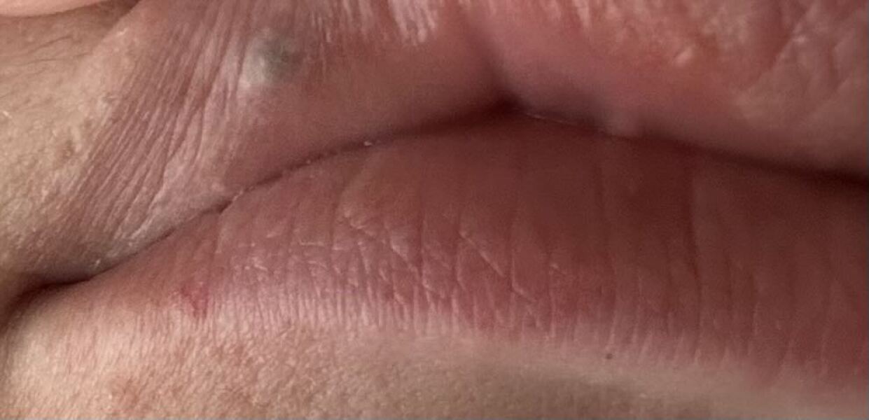 Black lump on top lip has appeared.