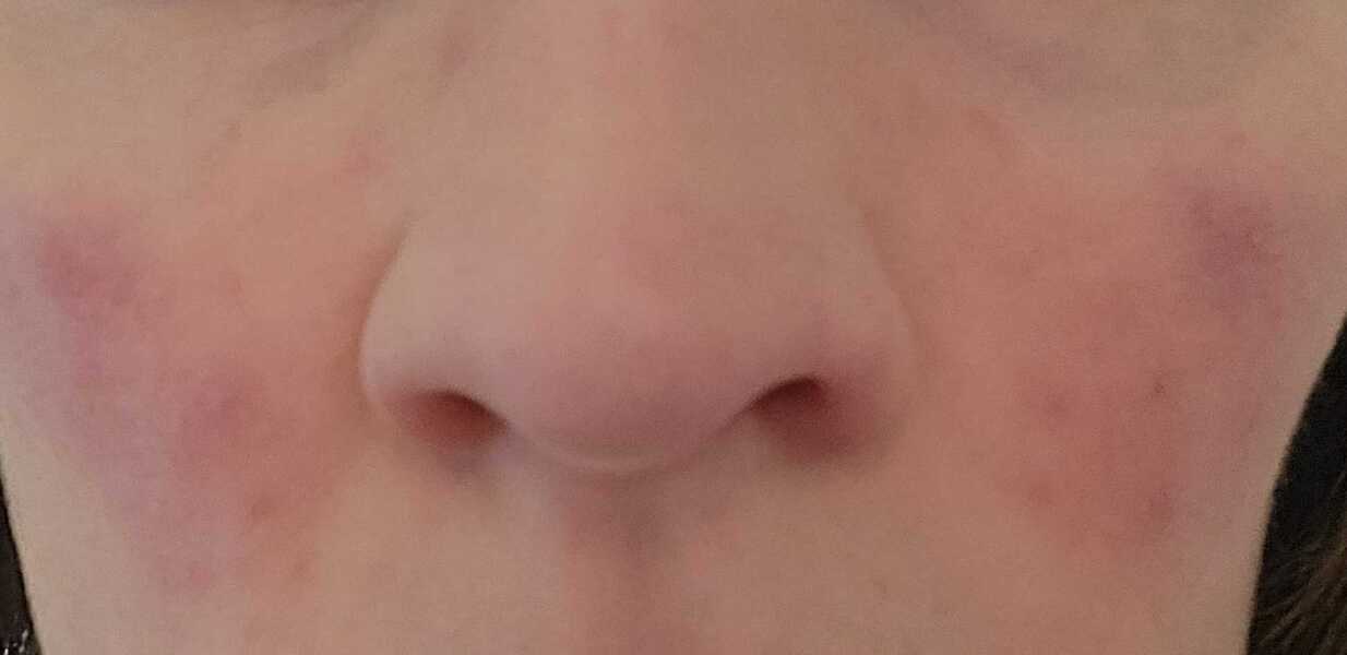 What am I doing wrong? (Redness on face - pic included)