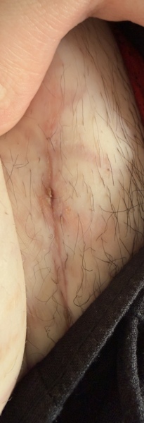 Five weeks postnatal and worried my caesarean scar is infected