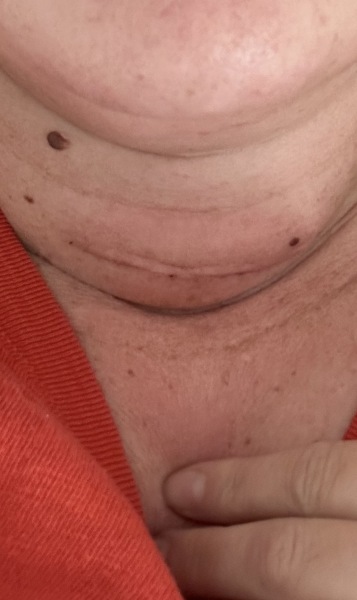Hemithyroidectomy for Thy3F nodule
