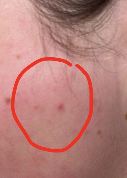raised spot on cheek won’t go