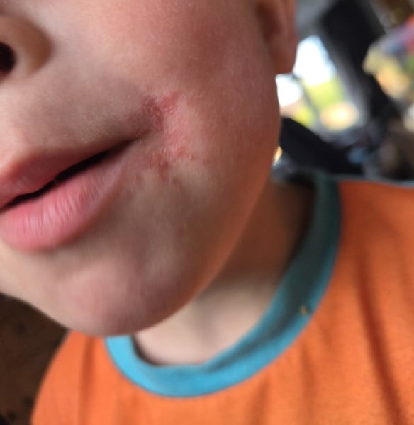 Persistent rash at the corner of my child’s mouth, any ideas?