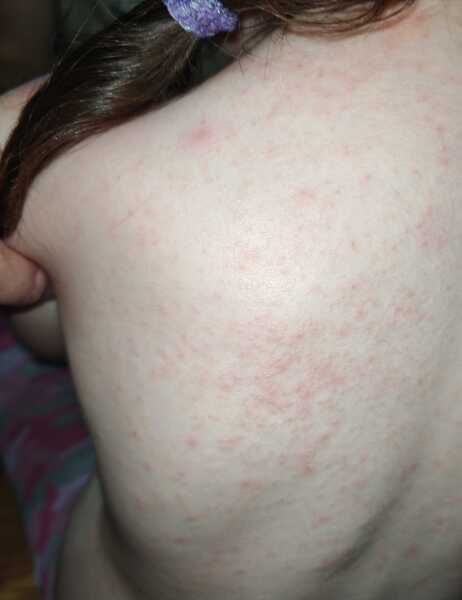 Scarlet fever or eczema?