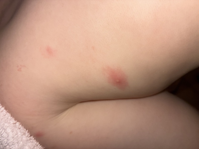 Two year old keeps getting unexplained spots
