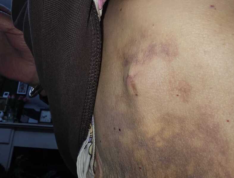 Bruising after surgery