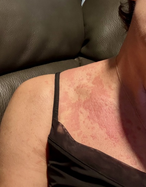 Woke up with an itchy burning rash on my chest