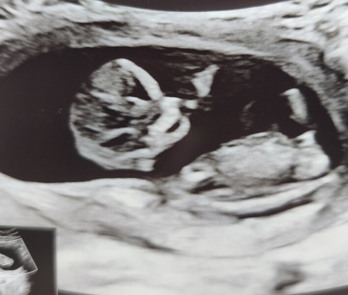 NUB THEORY - BOY OR GIRL?