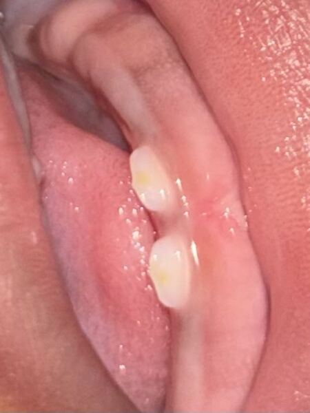 Yellow spots on baby’s teeth