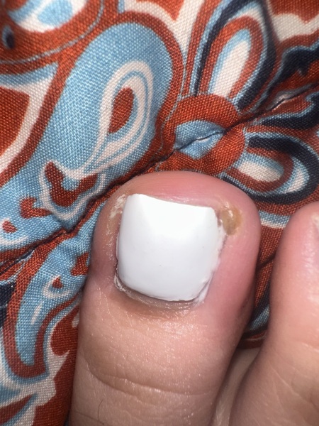 Infected toe?
