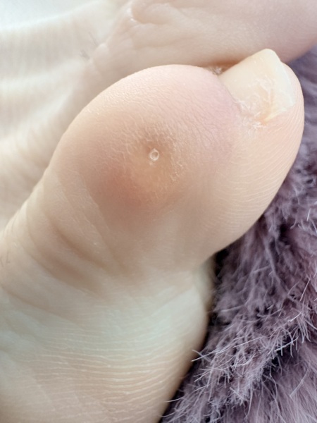 What’s on my toe?