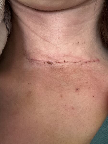 Hemithyroidectomy for Thy3F nodule