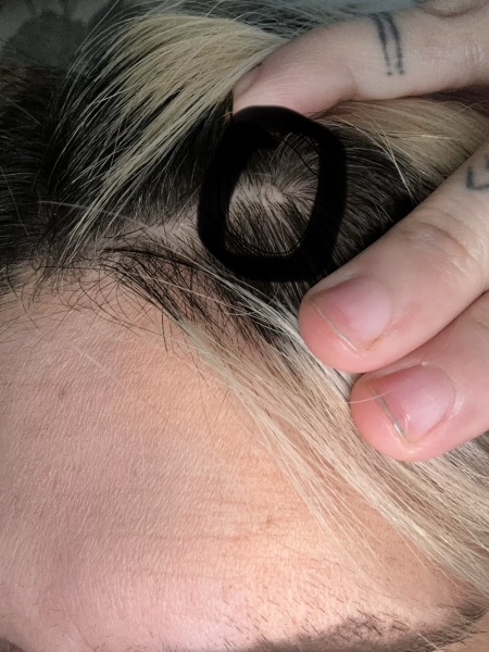 Small hard scalp lump for years, now worried after Googling